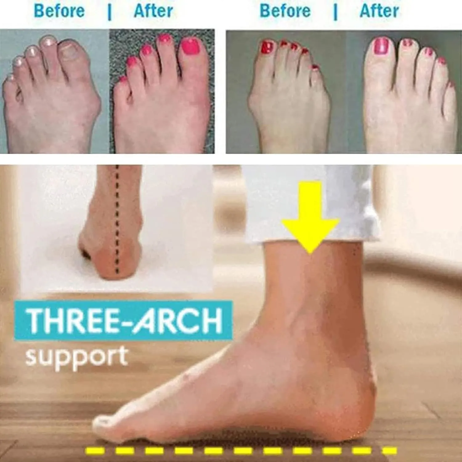 Bunion Orthopedic Sandals for Womens,Casual Lightweight Hallux Valgus Flat Slippers,Summer Roman Travel Ladies Beach Flip Flops,for Plantar Fasciitis/Foot Correction