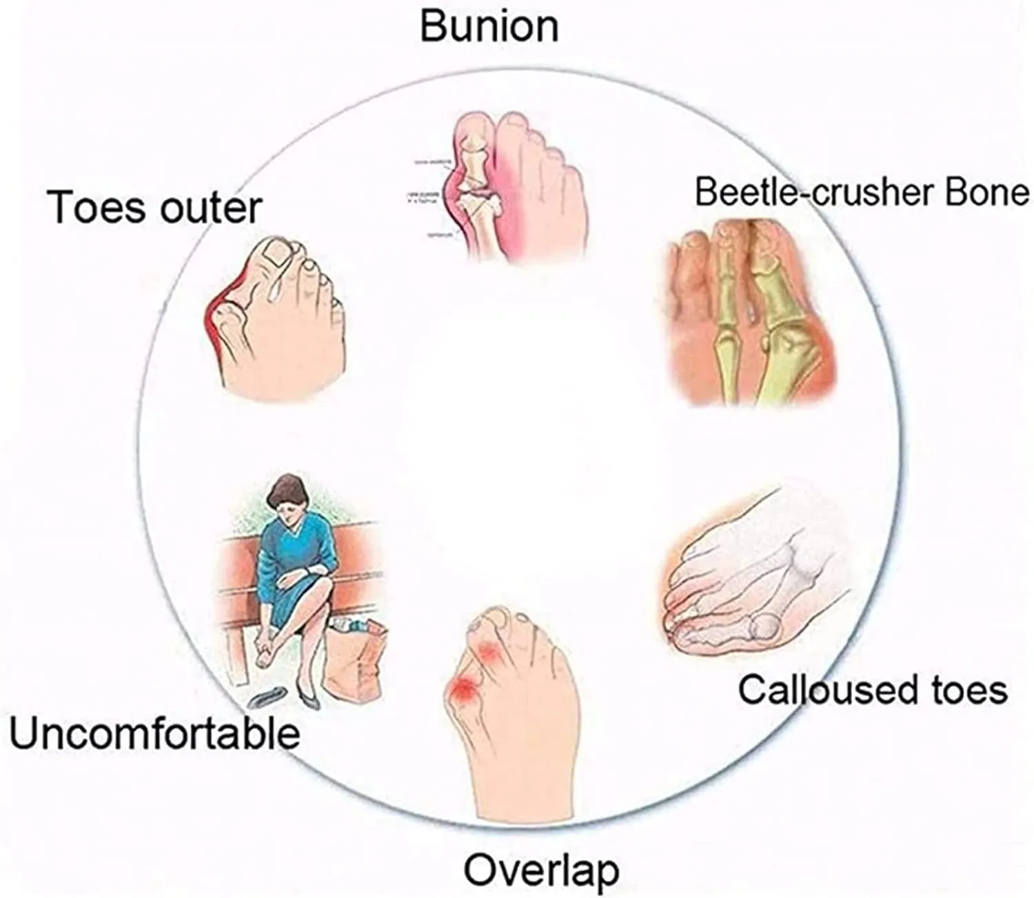 Bunion Orthopedic Sandals for Womens,Casual Lightweight Hallux Valgus Flat Slippers,Summer Roman Travel Ladies Beach Flip Flops,for Plantar Fasciitis/Foot Correction